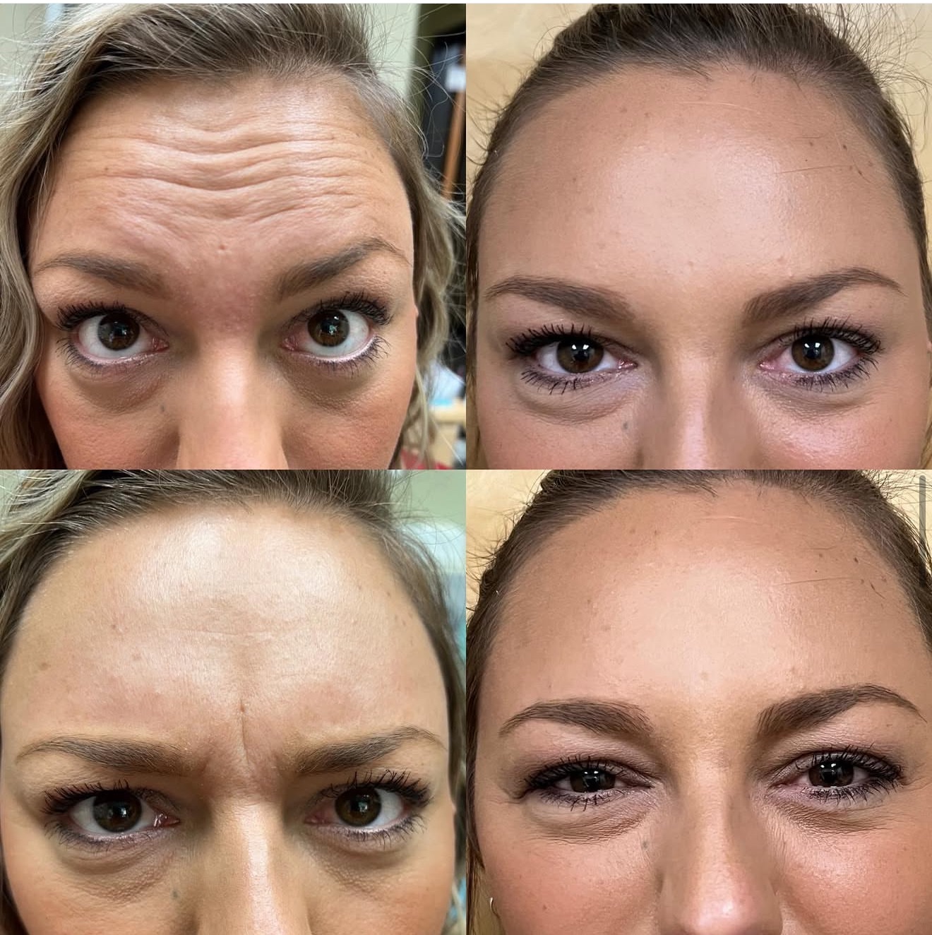 Botox Cosmetic Treatment