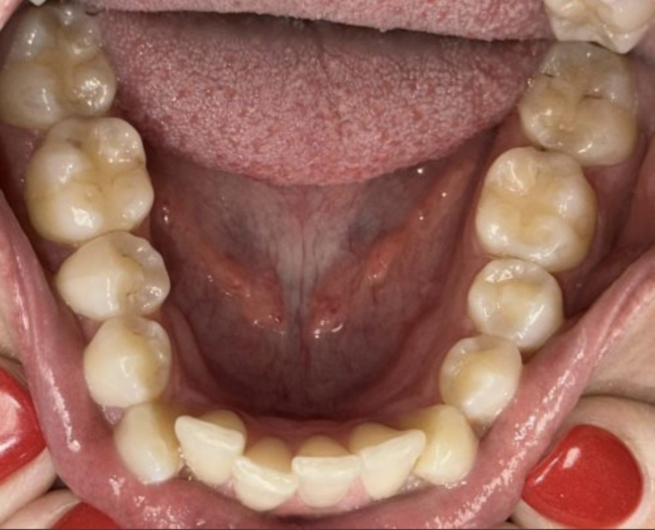 Before and After Invisalign