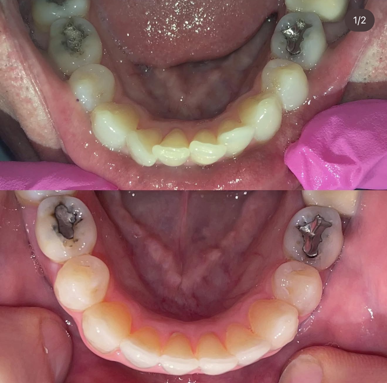 Invisalign Patient Results
