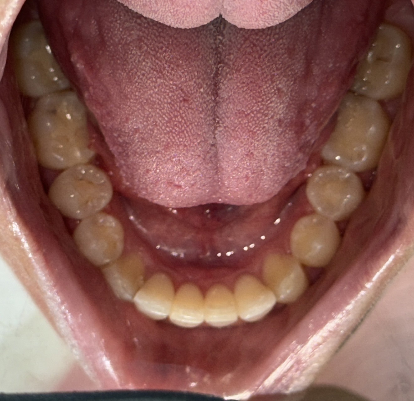 Invisalign Treatment