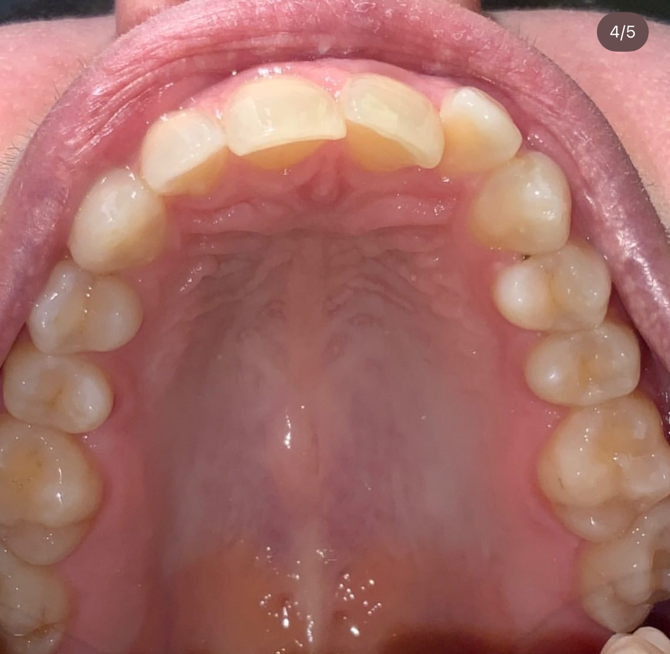 Invisalign Case Study