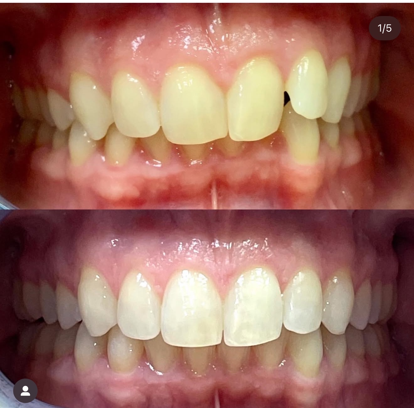 Invisalign Transformation