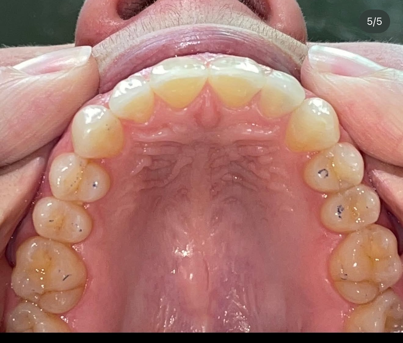 Invisalign Finished Results