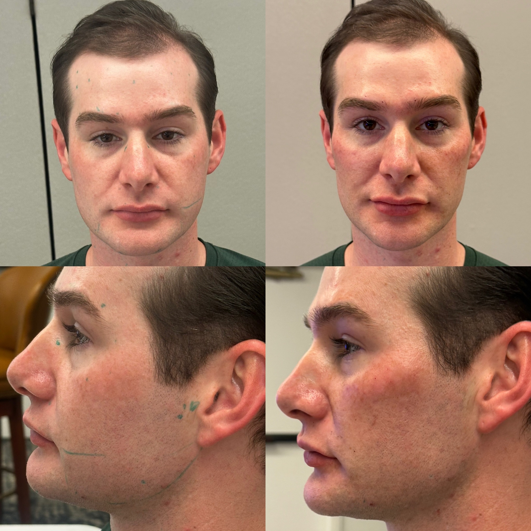 Juvéderm Treatment Results