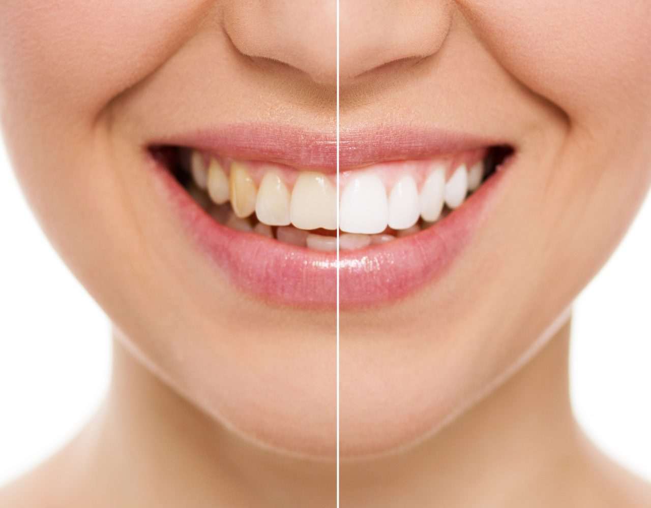 Before and after comparison of professional teeth whitening results